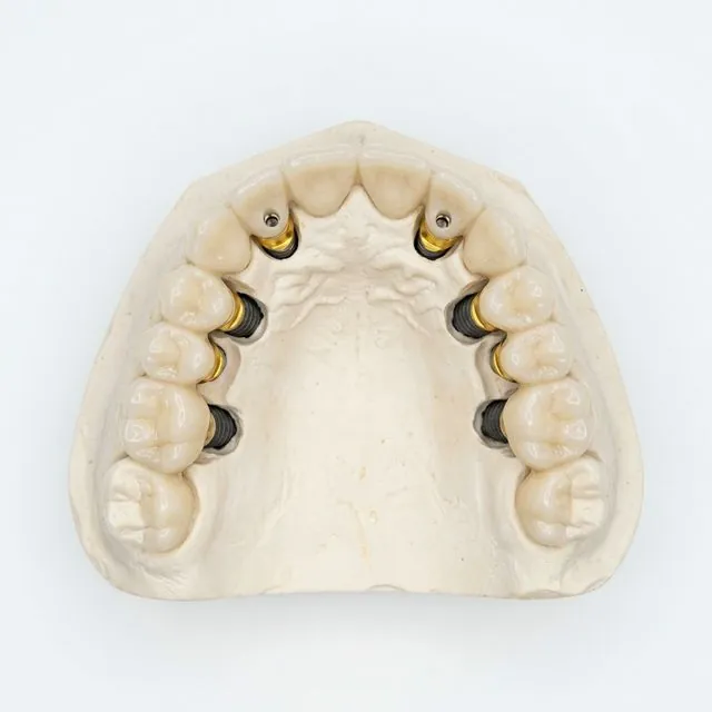 Modelo de arcada com 4 implantes All-on-4 em Belo Horizonte