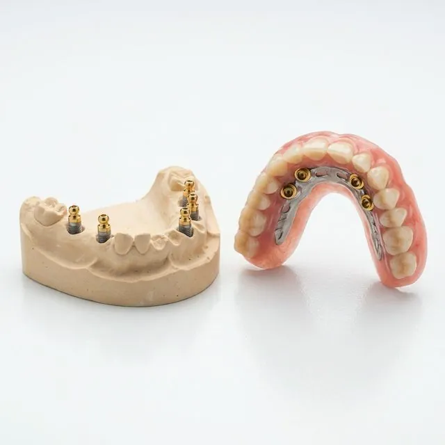 Overdenture com encaixes sobre implantes — tratamento disponível em Belo Horizonte
