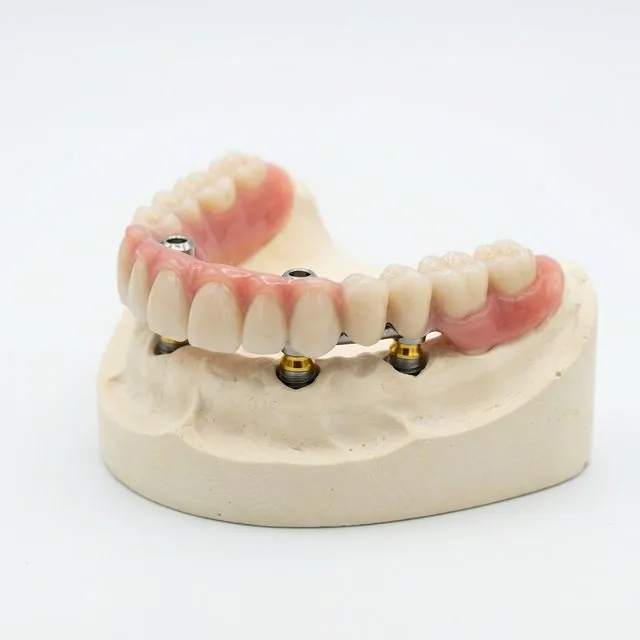 Prótese protocolo All-on-4 apoiada em implantes — tratamento disponível em Belo Horizonte