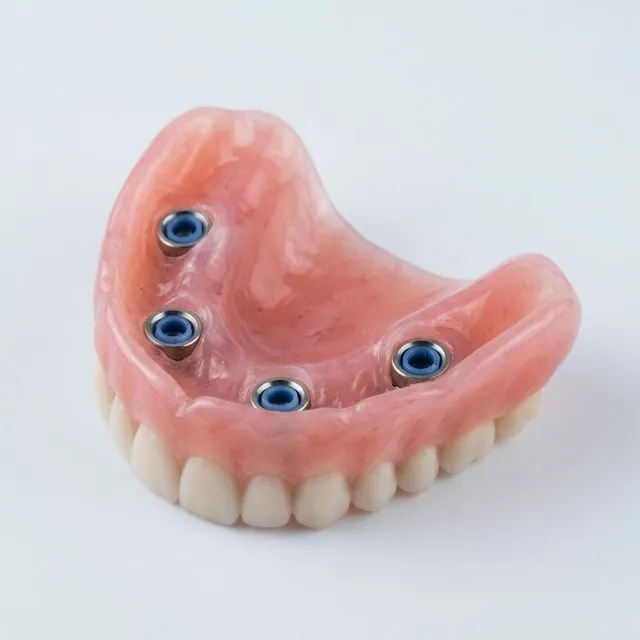 OVERDENTURE