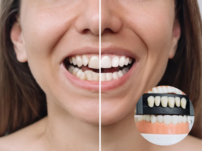 Sorriso alinhado e harmônico com facetas dentárias em Belo Horizonte