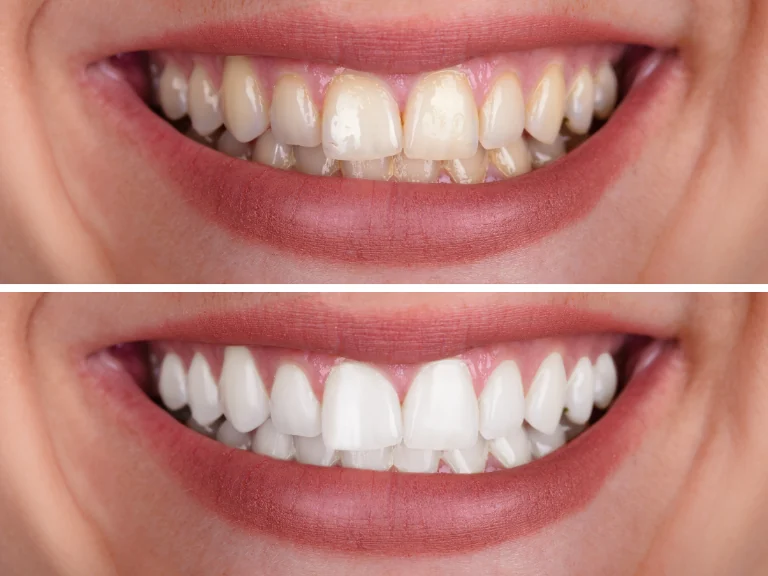 Sorriso mais branco e natural com lente de contato dental em Belo Horizonte
